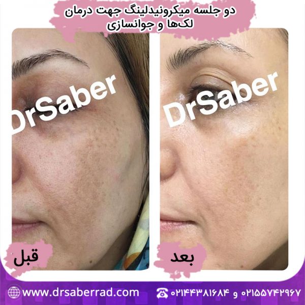 میکرونیدلینگ جهت درمان لک و جوانسازی