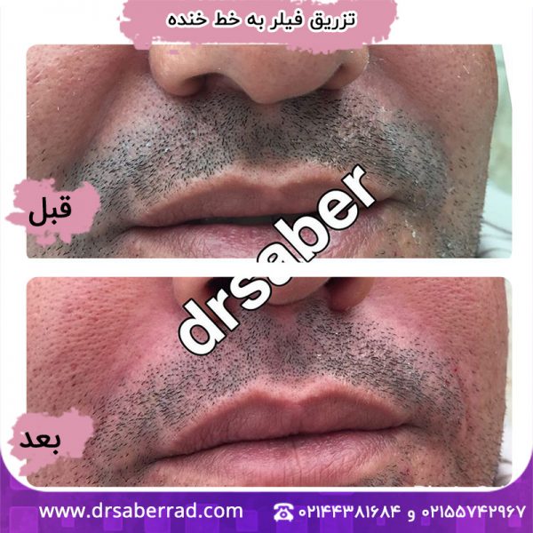 تزریق فیلر به خط خنده