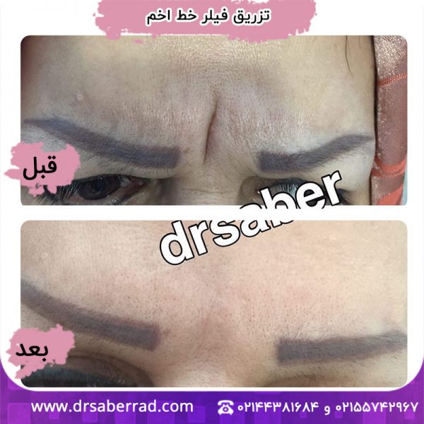 تزریق فیلر به خط اخم