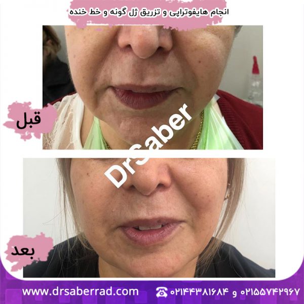 انجام هایفوتراپی و تزریق ژل گونه و خط خنده