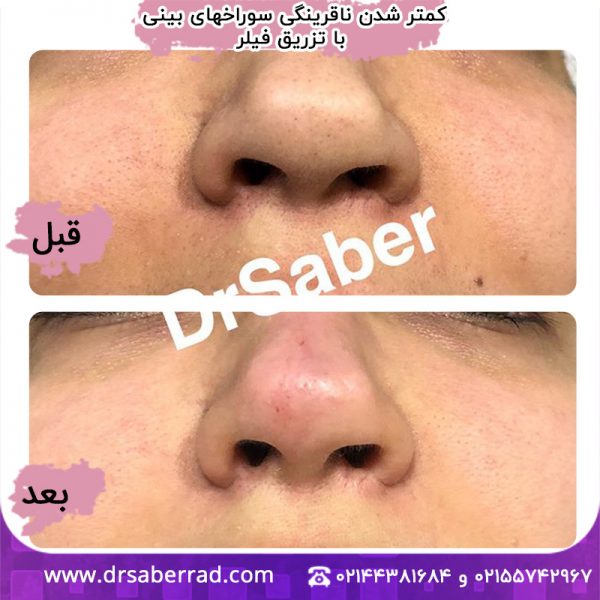 کمتر شده ناقرینگی سوراخهای بینی تا تزریق فیلر