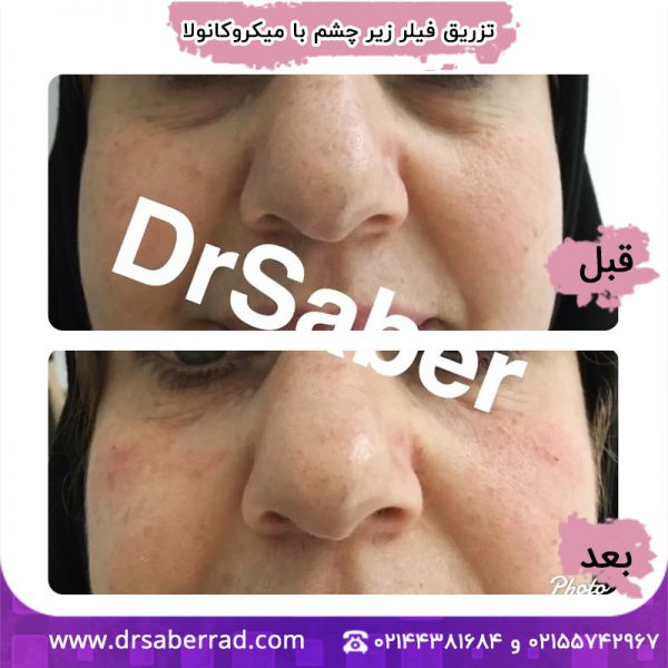 تزریق فیلر زیر چشم