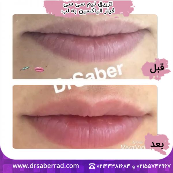 تزریق نیم سی سی فیلر به لب