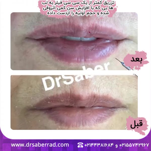 تزریق فیلر لب