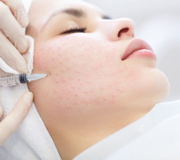 مزایا مزوفیلر