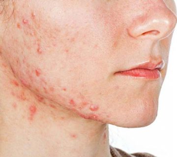 کدام مواد غذایی موجب بروز آکنه و جوش می شوند؟