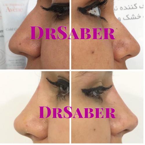 فیلر بینی